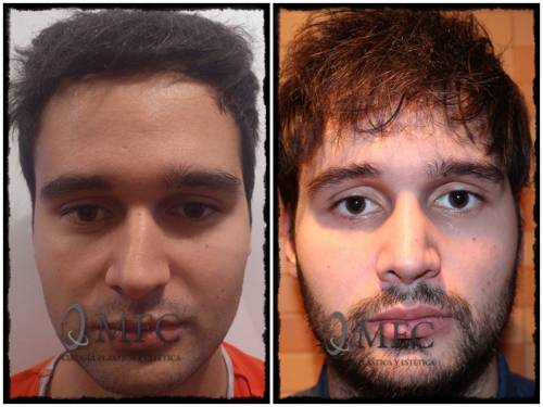 Rinoplastia